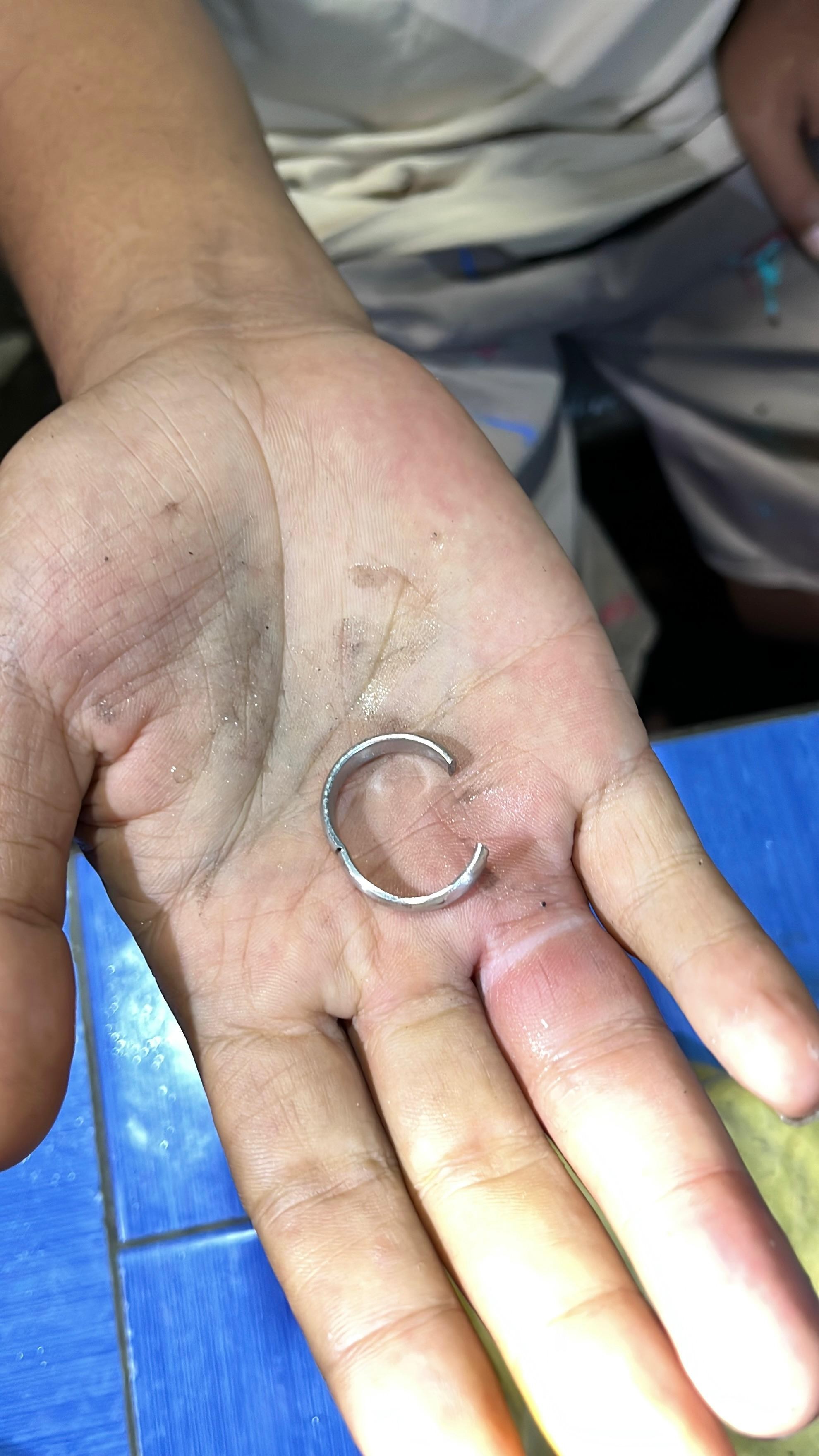 pelepasan cincin dari jari seorang warga yg tidak bisa dilepas yang beralamat di  Jl. Perbatasan