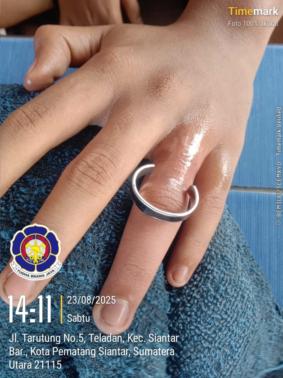 pelepasan cincin dari jari seorang warga yg tidak bisa dilepas yang beralamat di  Jl. Mangga Ujung