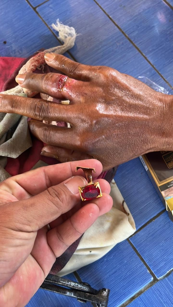 pelepasan cincin dari jari seorang warga yg tidak bisa dilepas.